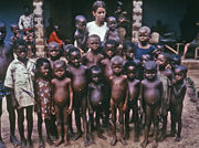 Children in this photograph from a Nigerian orphanage show symptoms of malnutrition, with four illustrating the gray-blond hair symptomatic of kwashiorkor.