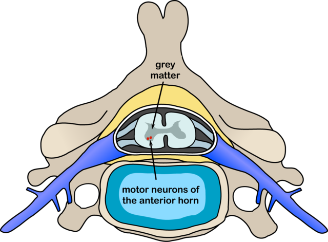 Image:Polio spinal diagram.PNG