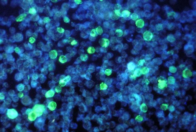 Image:Leukemia cells that contain Epstein Barrvirus using a FA staining technique PHIL 2984 lores.jpg