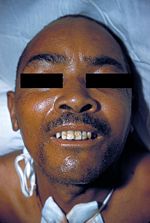 Lock-jaw in a patient suffering from tetanus.