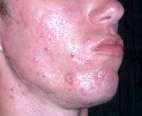 Acne of an older teenager.