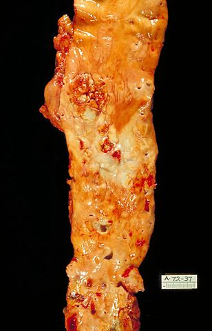 Image:Atherosclerosis, aorta, gross pathology PHIL 846 lores.jpg