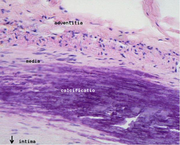 Image:Calcificatio atherosclerotica.jpg