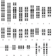 Karyotype for trisomy Down syndrome. Notice the three copies of chromosome 21