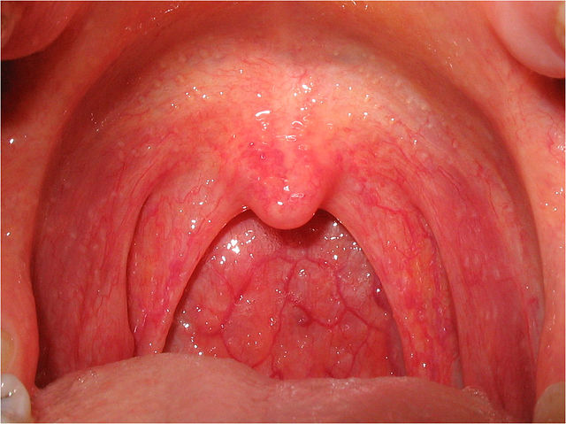 Image:Pharyngitis.jpg