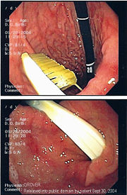 Endoscopic still of gastric foreign body (toothbrush)
