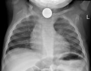 Chest X-ray showing a Canadian dollar coin in the esophagus of a young child