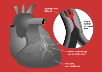 A myocardial infarction occurs when an atherosclerotic plaque slowly builds up in the inner lining of a coronary artery and then suddenly ruptures, totally occluding the artery and preventing blood flow downstream.