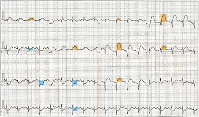 12-lead electrocardiogram showing ST-segment elevation (orange) in I, aVL and V1-V5 with reciprocal changes (blue) in the inferior leads, indicative of an anterior wall myocardial infarction.