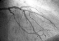 Angiogram of the coronary arteries.