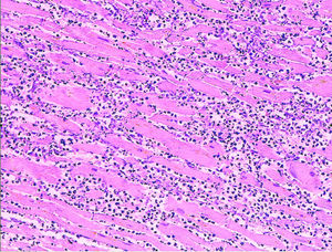 Microscopy image (magn. ca 100x, H&E stain) from autopsy specimen of myocardial infarct (7 days post-infarction).