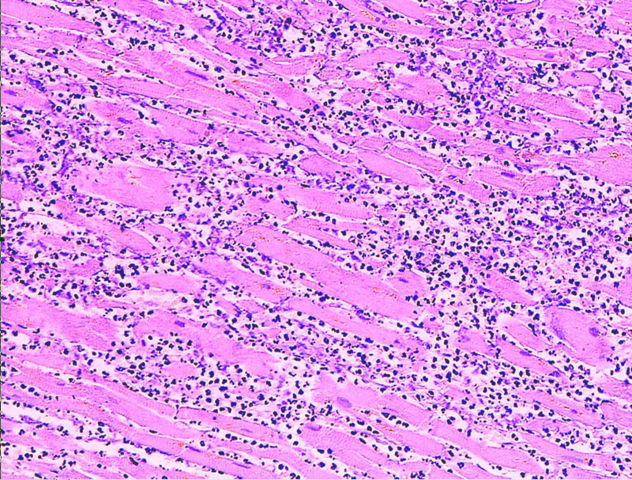 Image:Myocardial infarct emmolition phase histopathology.jpg