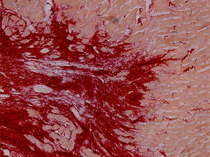 Microscopy image of myocardial infarction scar in the heart of a rat