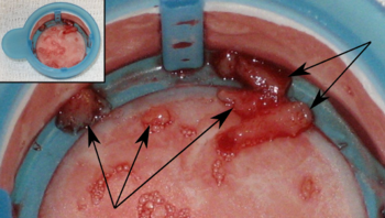 Thrombus material (in a cup, upper left corner) removed from a coronary artery during a percutaneous coronary intervention to abort a myocardial infarction.  Five pieces of thrombus are shown (arrow heads).