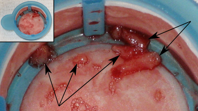 Image:Intracoronary thrombus.png