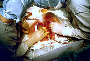 Coronary artery bypass surgery during mobilization (freeing) of the right coronary artery from its surrounding tissue, adipose tissue (yellow).  The tube visible at the bottom is the aortic cannula (returns blood from the HLM).  The tube above it (obscured by the surgeon on the right) is the venous cannula (receives blood from the body).  The patient's heart is stopped and the aorta is cross-clamped.  The patient's head (not seen) is at the bottom.