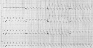 A 12 lead electrocardiogram showing ventricular tachycardia.