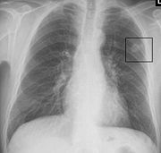 Chest x-ray showing lung cancer in the left lung.