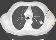 CT scan showing a cancerous tumor in the left lung