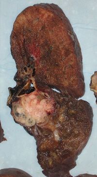 Pneumonectomy specimen containing a lung cancer, here a squamous cell carcinoma (the whitish tumor near the bronchi).