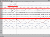 REM Sleep. EEG highlighted by red box. Eye movements highlighted by red line.