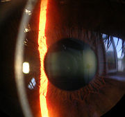 Slit lamp image of the cornea, iris and lens