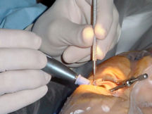 Cataract surgery, using a temporal approach phacoemulsification probe (in right hand) and "chopper" (in left hand) being done under operating microscope at a Navy medical center