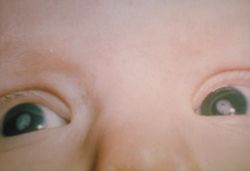 Bilateral cataracts in an infant due to Congenital rubella syndrome, courtesy CDC