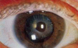 Slit lamp photo of Anterior capsular opacification visible a few months after implantation of Intraocular lens in eye, magnified view