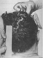 Drawing depicting the posterior head wound of President Kennedy. Made from an autopsy photograph