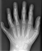 X-ray of the left hand of a ten year old boy with polydactyly.