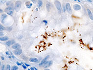 Immunohistochemical staining of H. pylori from a gastric biopsy.
