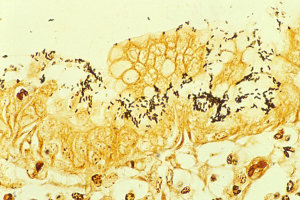 H. pylori colonized on the surface of regenerative epithelium (image from Warthin-Starry's silver stain)
