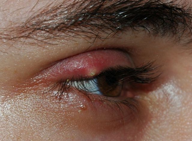 Image:Stye02.jpg