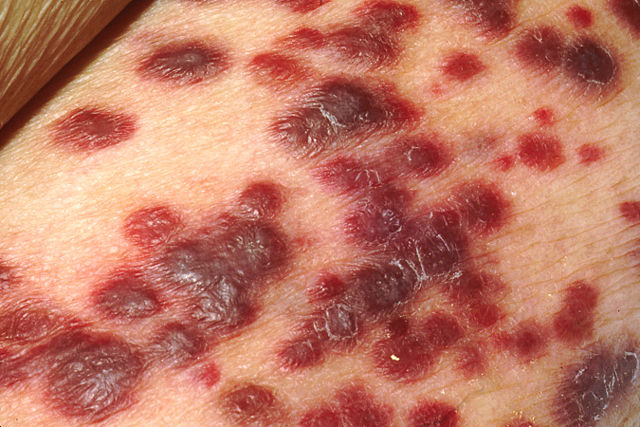 Image:Kaposi's Sarcoma.jpg