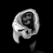 Para-sagittal MRI of the head