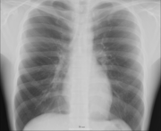 An X-ray of a human chest.