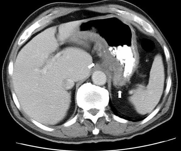 Image:CT scan gastric CD.jpg