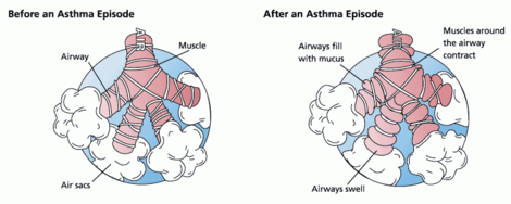 Inflamed airways and bronchoconstriction in asthma. Airways narrowed as a result of the inflammatory response cause wheezing.