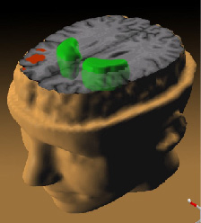 Data from a PET study suggests that the less the frontal lobes are activated (red) during a working memory task, the greater the increase in abnormal dopamine activity in the striatum (green), thought to be related to the neurocognitive deficits in schizophrenia.