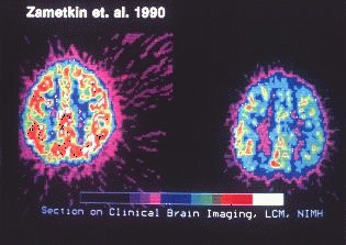 PET scans of glucose metabolism in the brains of a normal adult (left) compared to an adult diagnosed with ADHD (right). "This PET scan was taken from Zametkin's landmark 1990 study, which found lower glucose metabolism, in the brains of patients with ADHD who had never taken medication. Scans were taken while patients were engaging in tasks requiring focused attention. The greatest deficits were found in the premotor cortex and superior prefrontal cortex."