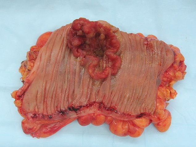 Image:Colon cancer 2.jpg