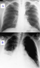 Pneumonia as seen on chest x-ray.  A: Normal chest x-ray. B: Abnormal chest x-ray with shadowing from pneumonia in the right lung (white area, left side of image).