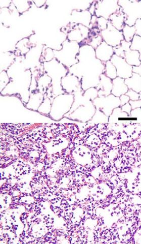 Image:Pneumonia alveolus.jpg