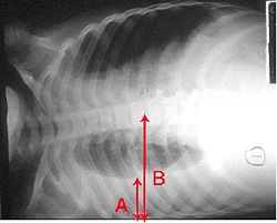 Pleural effusion. Chest x-ray showing a pleural effusion. The A arrow indicates "fluid layering" in the right chest. The B arrow indicates the width of the right lung. The volume of useful lung is reduced because of the collection of fluid around the lung.