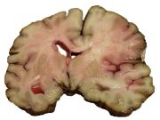 A slice of brain from the autopsy of a person who suffered an acute middle cerebral artery (MCA) stroke