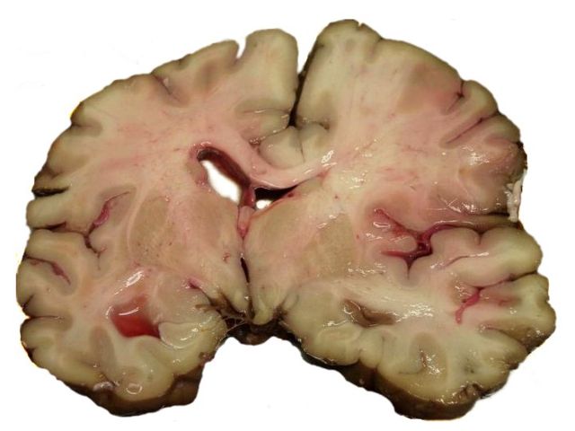 Image:MCA-Stroke-Brain-Human-2.JPG