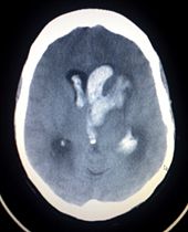 CT scan showing an intracerebral hemorrhage.