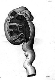 drawing of an enlarged kidney by John Hunter