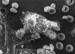 Macrophages have identified a cancer cell (the large, spiky mass). Upon fusing with the cancer cell, the macrophages (smaller white cells) will inject toxins that kill the tumor cell. Immunotherapy for the treatment of cancer is an active area of medical research.